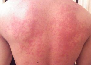 Аллергия на кошек у взрослых