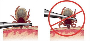 Как можно легко извлечь клеща