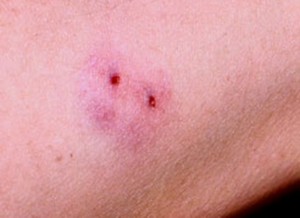 Важно действовать быстро и постараться удалить из ранки как можно больше яда