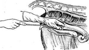 Цервикальный способ осеменения