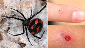 Чем опасен укус каракурта