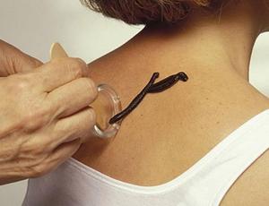 Виды опасных пиявок